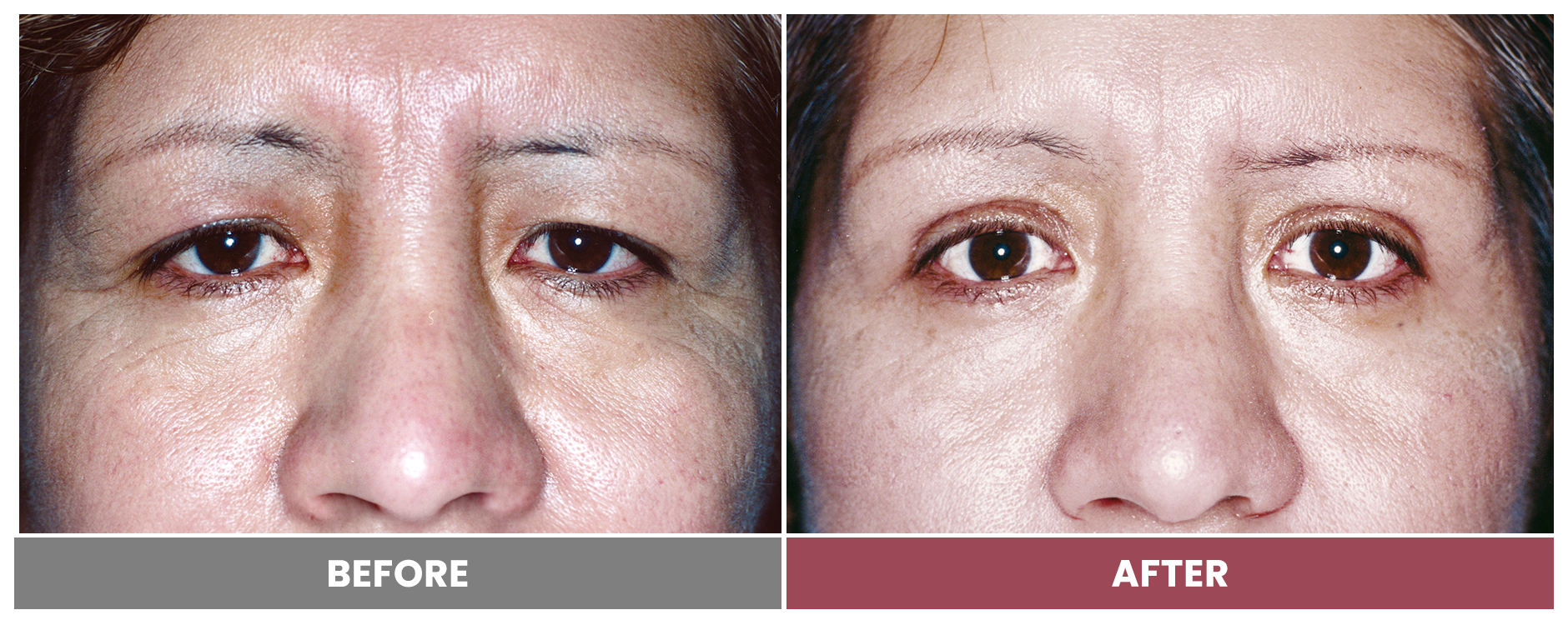 Upper Blepharoplasty - Case 85